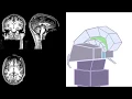 MRI 3D Brain Anatomy Hypothalamus Pituitary Gland Fornix Corpus Callosum 3rd Ventricle