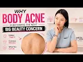 Body Acne Is the Next Big Skincare Concern - Here s Why
