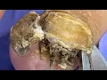 Download Lagu Super dirty onychomycosis, the germs have completely turned into black mud【Doctor Liu Pedicure】