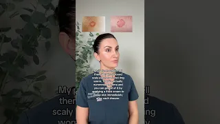 Nummular Eczema vs Ringworm How to Treat Round Scaly Patches
