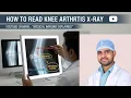 How to Read Knee joint X ray How to read knee x ray report