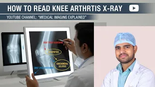 How to Read Knee joint X ray How to read knee x ray report
