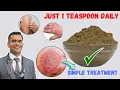 Just 1 Teaspoon Daily To Cure all Your Skin Problems Eczema - Simple Treatment