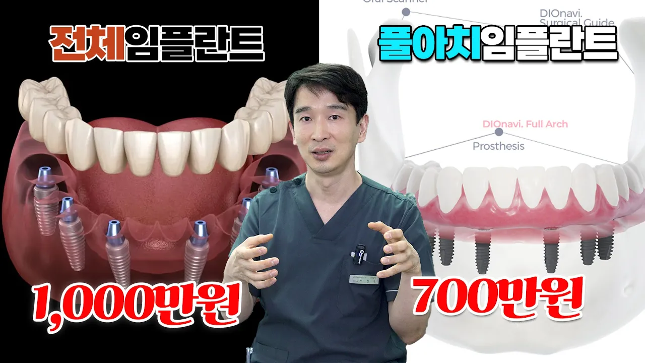 전체 임플란트, 임플란트 틀니, 풀아치 임플란트 영상 하나로 치과에서 1000만원 아끼는 방법!