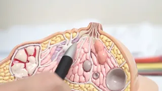 สาเหตุหลักของมะเร็งเต้านม มีอะไรบ้าง และเกี่ยวข้องกับฮอร์โมนอย่างไร