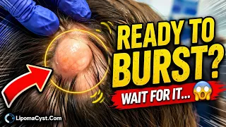 Five Massive Pilar Cysts  in one go! ￼