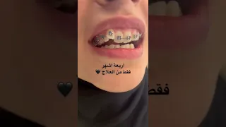 نتيجة تقويم الاسنان قبل وبعد Dr Abdullah Sultan Dentist Dentist Dental 소아치과 Anesthesia 