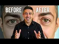 Lagu Your Eyes Are Aging Faster Than You Think (And How to Stop It Naturally)