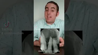 Commonly confused inflammatory vs dentigerous cyst Do you know the difference
