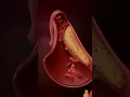 Download Lagu किस तरह आता है हार्ट अटैक ?How Does a Heart Attack Happen? Step-by-Step Explanation!