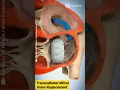 Download Lagu Altavalve: Transcatheter Mitral Valve Replacement (TMVR) #shorts #medical #animation