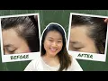 How I Fixed My Thinning Hair Hairmax Laserband 82 Review with Before After Results