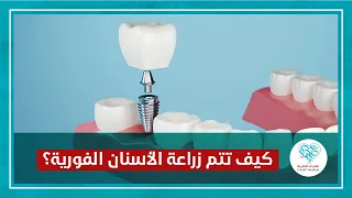 كيف تتم زراعة الأسنان الفورية بعد قلع الأسنان   زراعة الاسنان  زراعة الاسنان الفورية دندنها