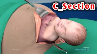 عملية الولادة القيصرية كاملة Watch The Caesarean Section 