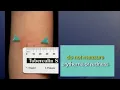 Reading a TB Skin Test