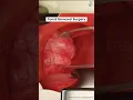 Download Lagu Tonsil Removal Surgery ↪ 3D Medical Animation #Tonsil #Tonsillectomy #Surgery #Shorts