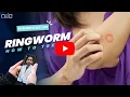 Ringworm How To Treat - Struggling with ringworm