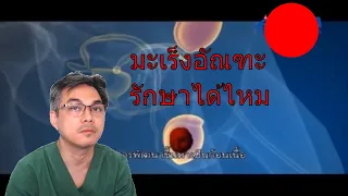 โรคมะเร็งอัณฑะเกิดจากอะไร และมีปัจจัยเสี่ยงหลักคืออะไร