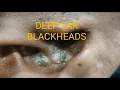 Deep ear Blackheads Removal
