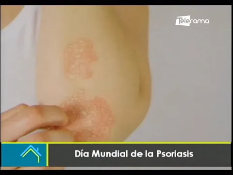 Día Mundial de la Psoriasis