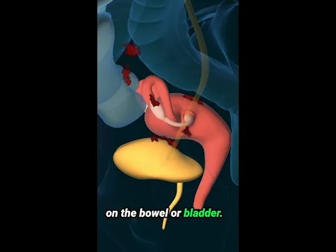 Endometriosis Explained #pain