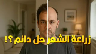 هل اللي بيزرع شعر شعره الجديد مش بيقع مع الوقت 