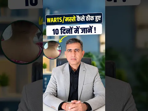 10 दिन में मस्से (Warts) जड़ से गायब? | Homeopathy Real Case Study #Shorts
