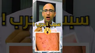 السبب الحقيقي للجرب دندنها
