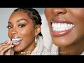 Lagu MY INVISALIGN JOURNEY | PART 1: How much it costs? Does it hurt? Getting Started? | Slim Reshae