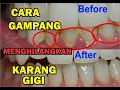 Download Lagu cara Gampang menghilangkan karang gigi yang sudah mengeras dengan bahan alami