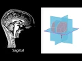 MRI 3D Brain Anatomy Internal Capsule Thalamus Brainstem