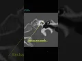 Download Lagu Preop CT scan for Otosclerosis Stapedectomy _Dr Nirmal Patel #ears#shorts #otosclerosis