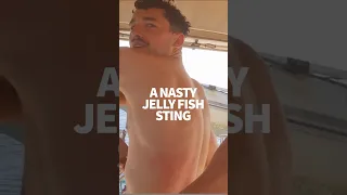 Portuguese Man of War jelly fish sting hurts! #windedvoyage #sailinglifestyle #boatlife #africa