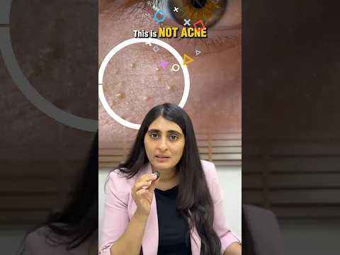 Milia Treatment| How to remove milia? Dermatologist Guide for Milia
