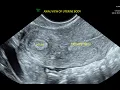 Download Lagu Accessory and Cavitated Uterine Mass (ACUM) - 2D and 3D Ultrasound