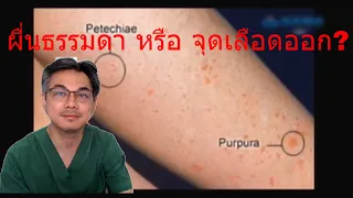 โรค ITP คืออะไร และเกี่ยวข้องกับระบบใดในร่างกาย