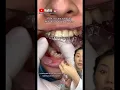 Trick to remove Invisalign