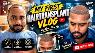 My First Hair Transplant Vlog / Hair Transplant Day 1