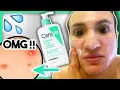 I used CeraVe Foaming Facial Cleanser for ONE WEEK it broke me out