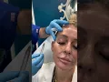 Expert Temple Filler injection in Plantation