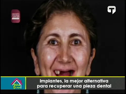 Implantes, la mejor alternativa para recuperar una pieza dental