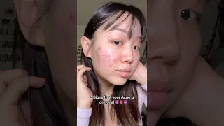 How I knew my acne was Hormonal