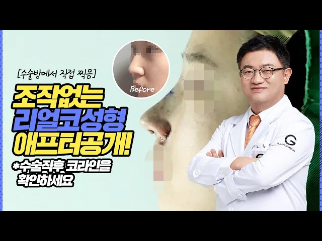 [수술방에서 직접 찍음]조작없는 리얼 코성형 애프터 공개♡ 1편 *긴얼굴 코성형 편*