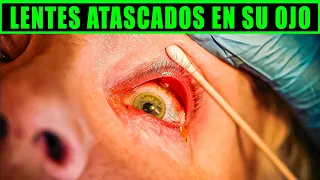TENIA DECENAS DE LENTES DE CONTACTO ATASCADOS EN EL OJO