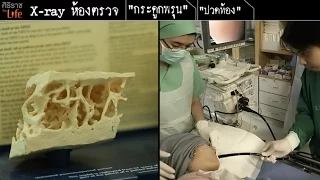 โรคกระดูกพรุนคืออะไร และทำไมจึงเรียกว่า "ภัยเงียบ" ของผู้หญิงวัยสูงขึ้น?