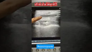  อาการเจ็บข้อเท้าที่เกิดจากโรคเกาต์ มีลักษณะอย่างไรบ้าง 