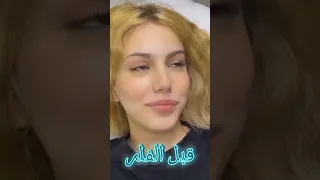 قبل وبعد نارو تسوي فلر شنو رايكم نارو بارق نبأ العراق 