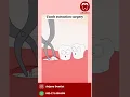 Download Lagu Berikut ilustrasi pencabutan gigi yang terimpaksi                          Cr : mocoo