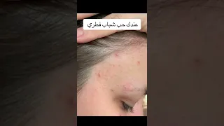 حبوب وجه سببها فطري انتبهوا 