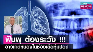  ฟันผุสามารถทำให้เกิดภาวะแทรกซ้อนที่ร้ายแรงได้หรือไม่ 